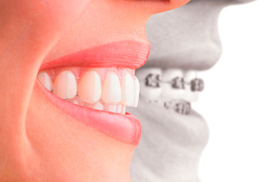 Гарантии на ортодонтические аппараты