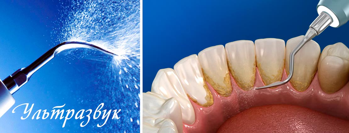 Чистка ультразвуком удаляет зубной камень над и под десной